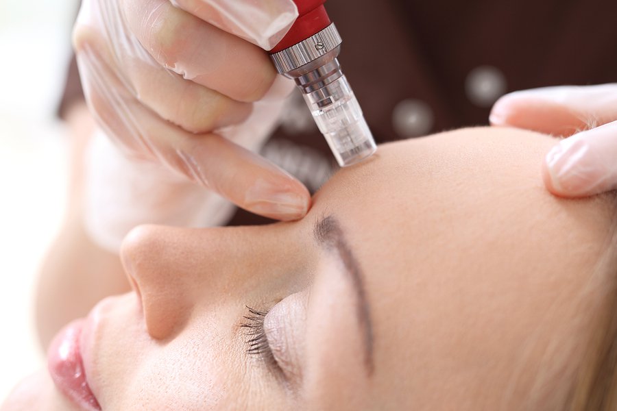 Woman receiving micro needling therapy in Dallas, Texas Woman receiving micro needling therapy in Dallas, Texas