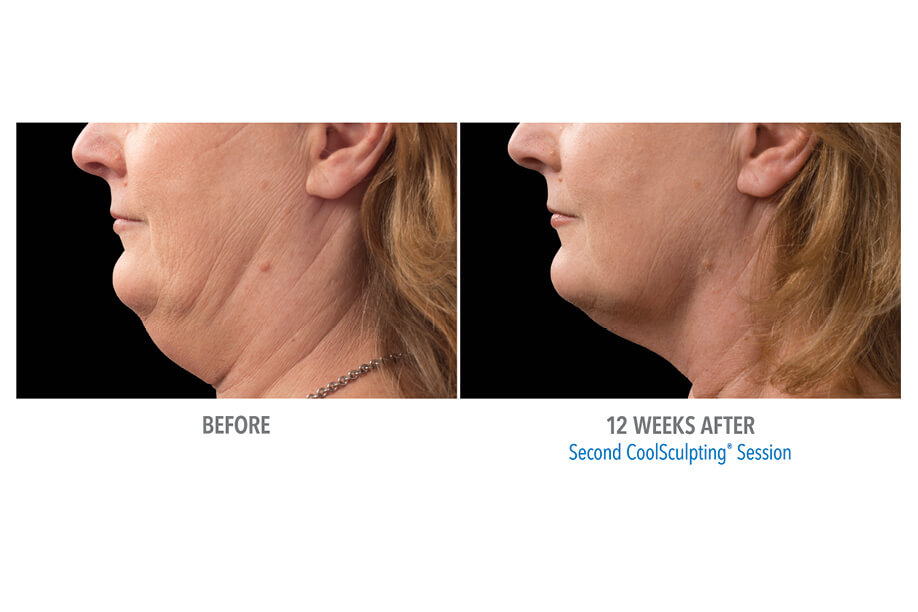 Coolsculpting before and after