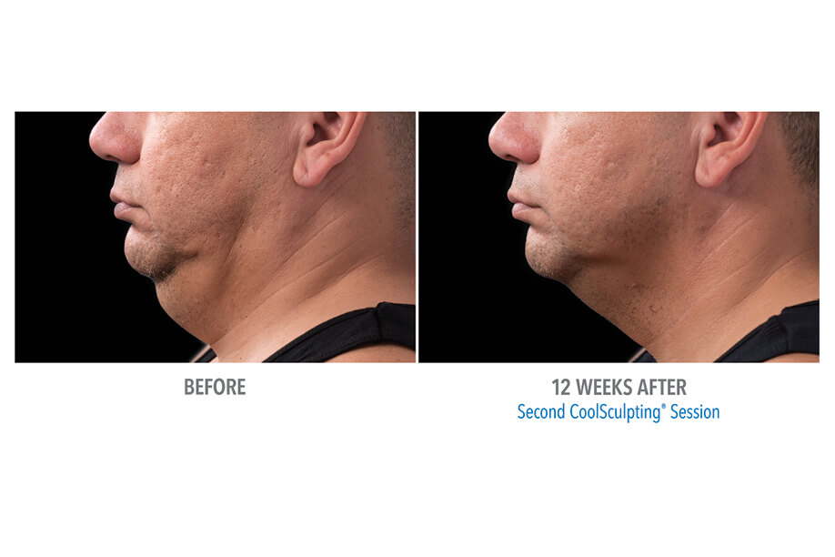 Coolsculpting before and after