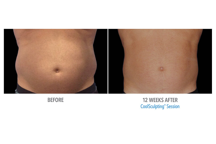Coolsculpting before and after