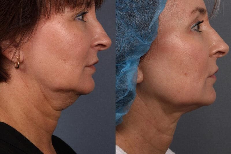 Before & After Kybella Treatment