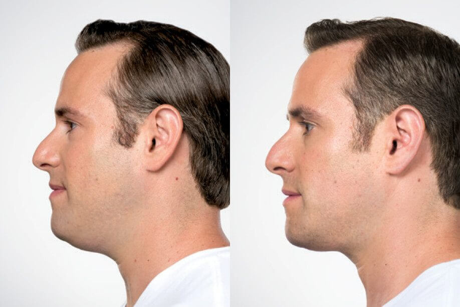Before & After Male Kybella Treatment