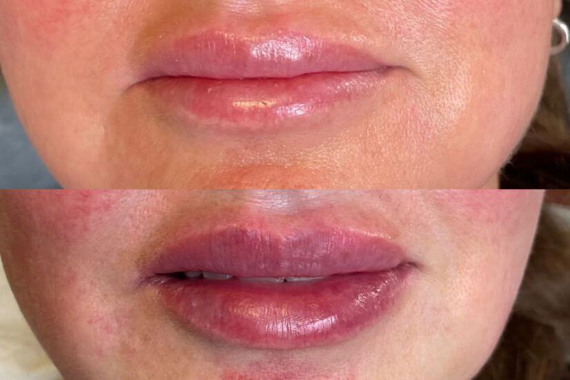 Before & After RHA Injectable Lip Filler