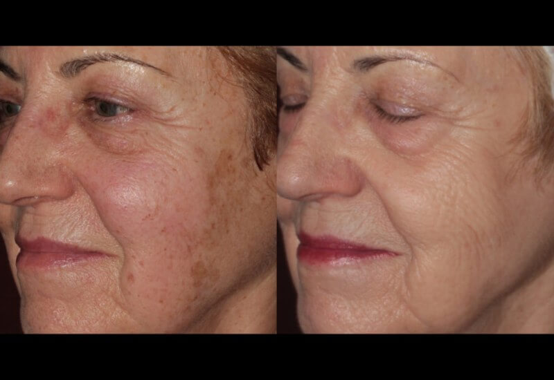 Forever Young Treatment Before & After