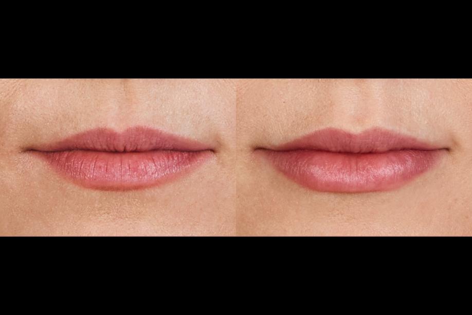 Juvéderm Ultra XC before and after
