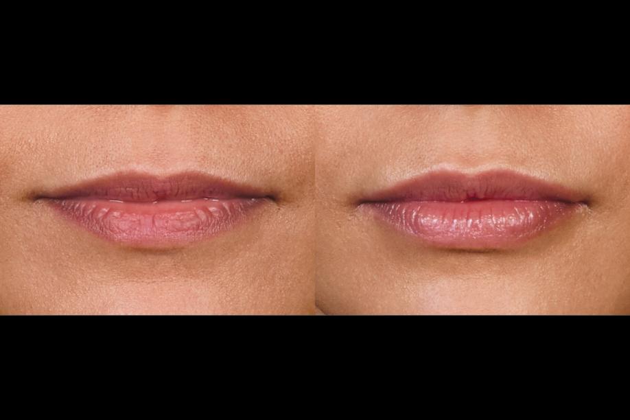 Juvéderm Ultra XC before and after