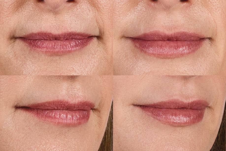 Juvéderm Volbella before and after