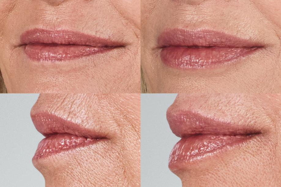 Juvéderm Volbella before and after