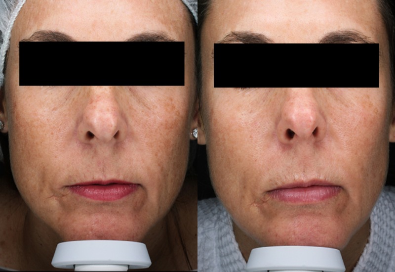 Before and After treatment of older lady