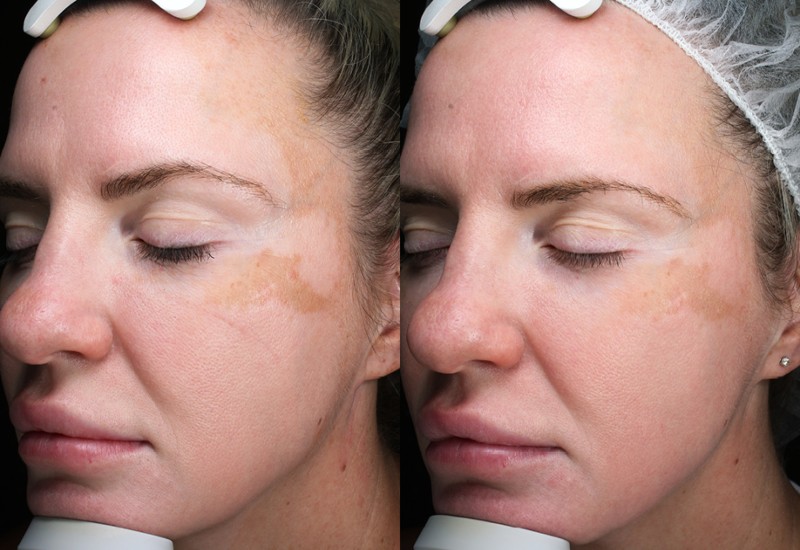 Lady with skin problem in face