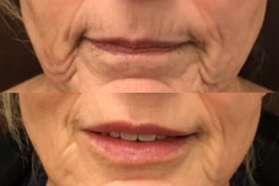 RHA Injectable Filler before and after