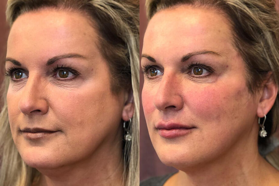 RHA Injectable Filler before and after