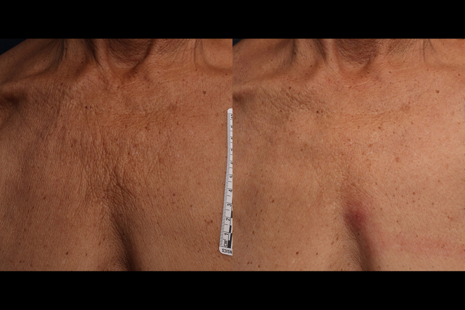 Ultherapy before and after