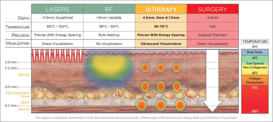 ultratherapy results graph