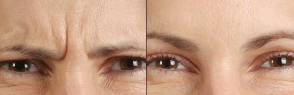 Botox before and after