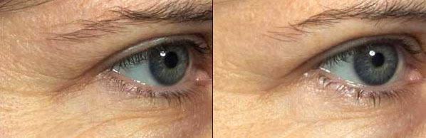 fraxel refine treatment