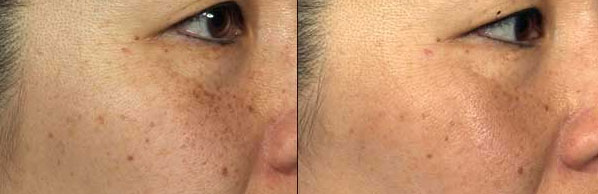 fraxel refine pigment treatment