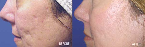 fraxel repair treatment