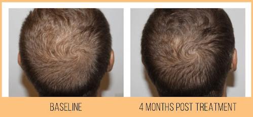 Before and after 4 month post treatment of Hydrafacial scalp treatment in Dallas, TX