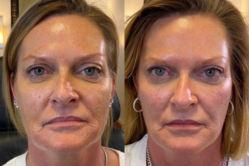 Before & After Restylane Treatment
