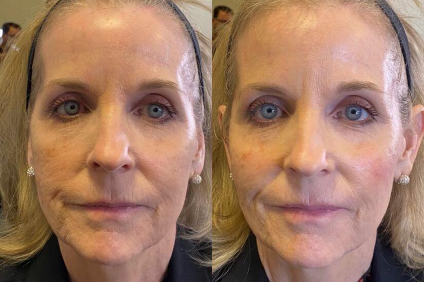 Before & After Restylane