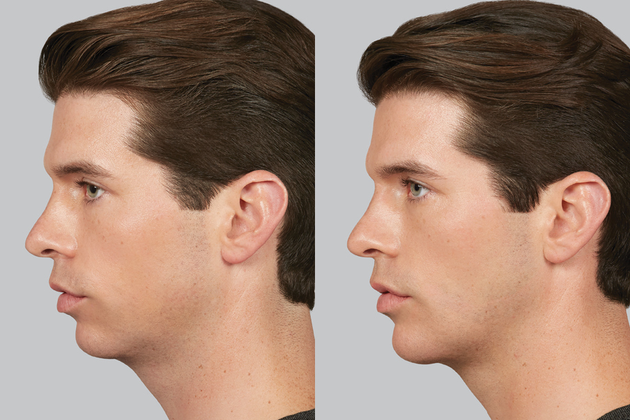 Before and after Juvéderm Voluma in Dallas, TX