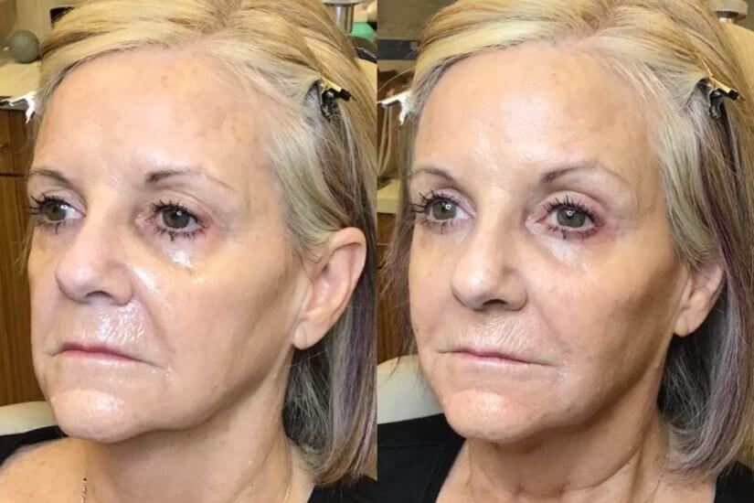Restylane Before & After