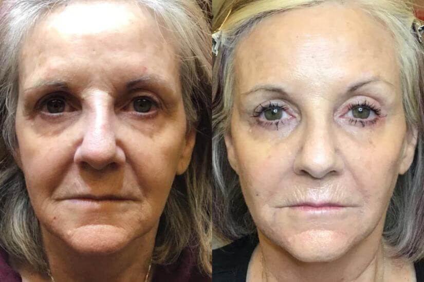 Restylane Treatment Before & After