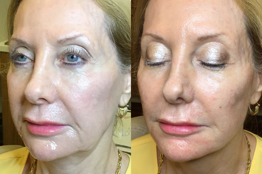 Restylane before and after image