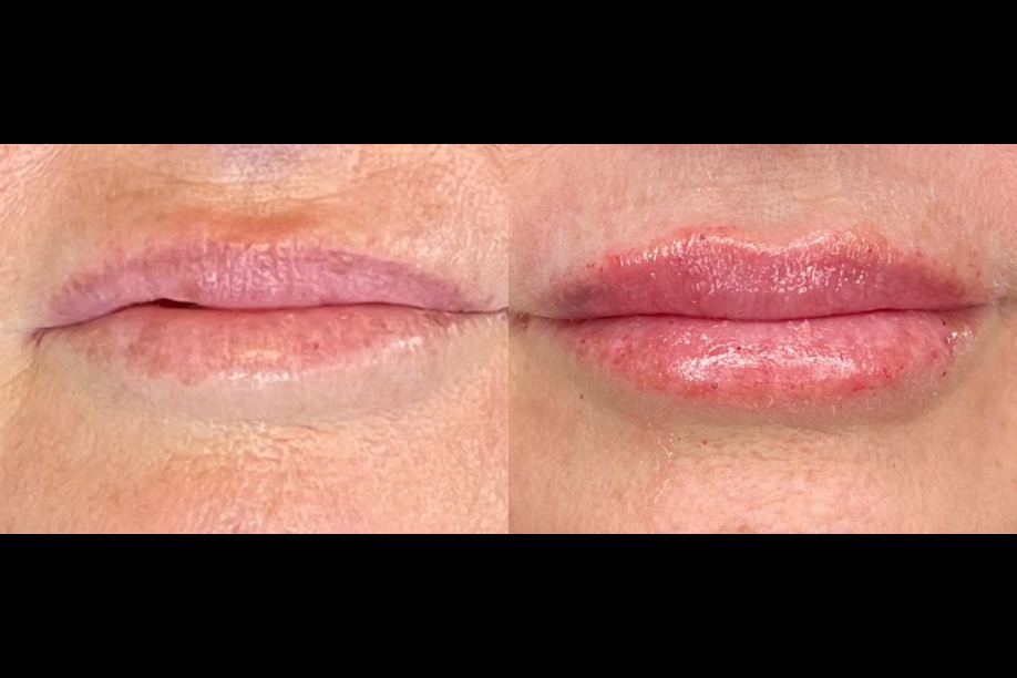 Juvéderm Volbella before and after lips image