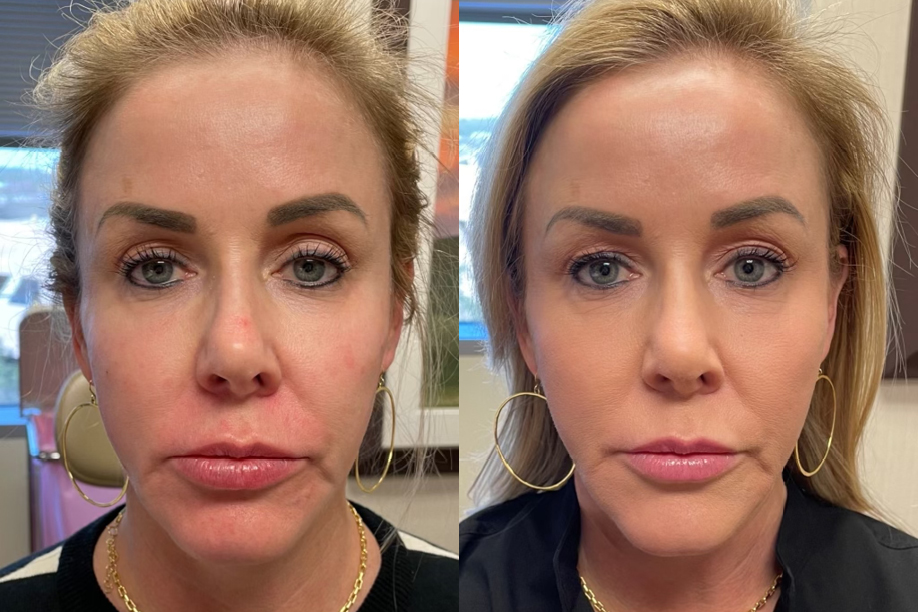 Before and after face Juvedermvoluma