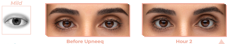Eyelid Lift Without Surgery