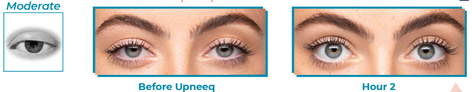 Upneeq Moderate eyelid lift without surgery