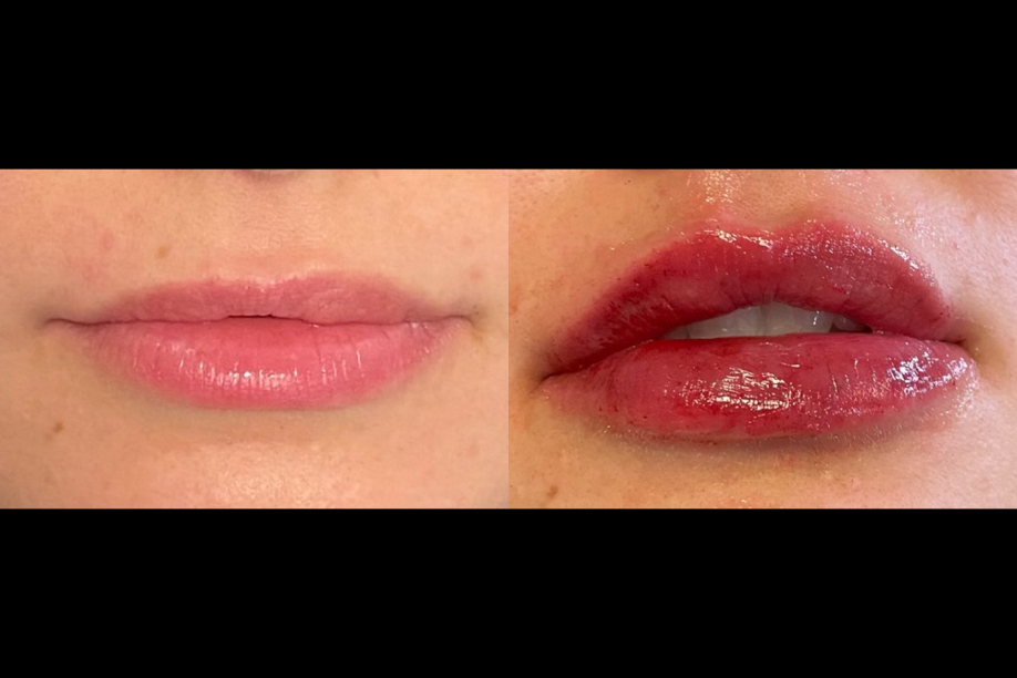 Before and after Juvederm Ultra XC9 treatment for lips