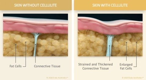 Skin With & Without Cellulite