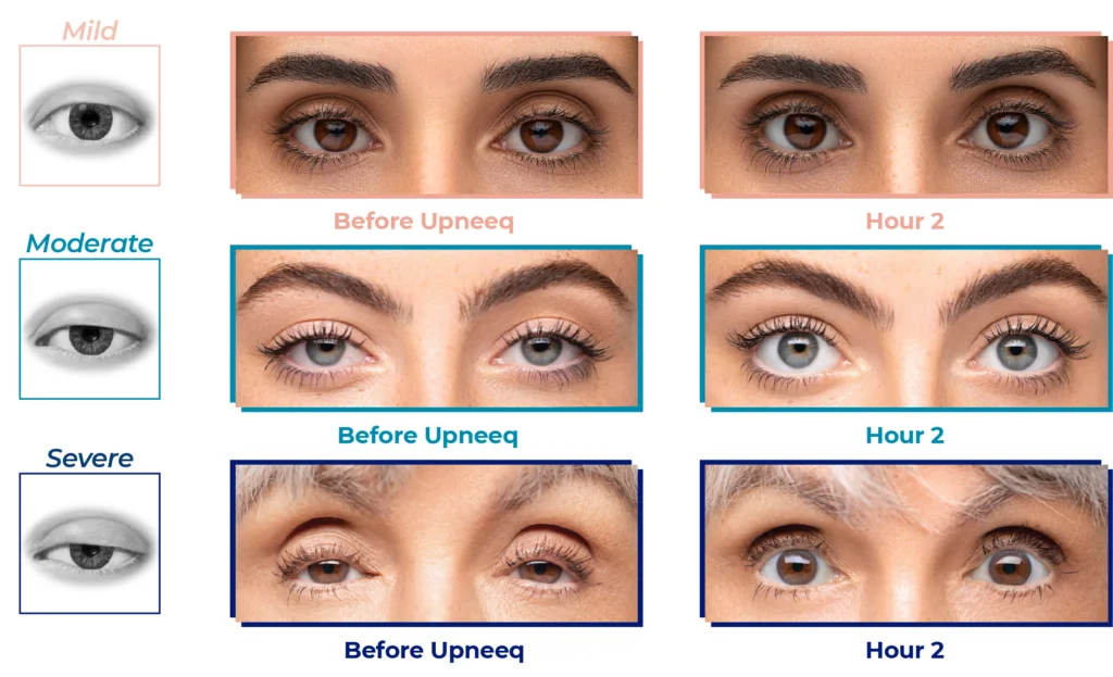 UPNEEQ is a prescription eye drop that temporarily improves droopy eyelids