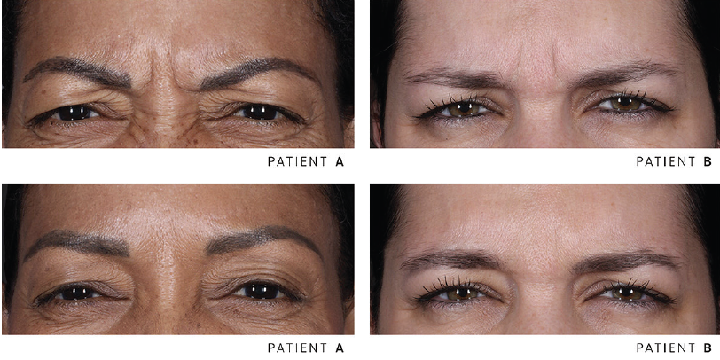 Before and after Wrinkle Reduction for men and women 