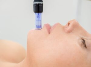 Woman receiving microneedling with SkinPen in Dallas, TX