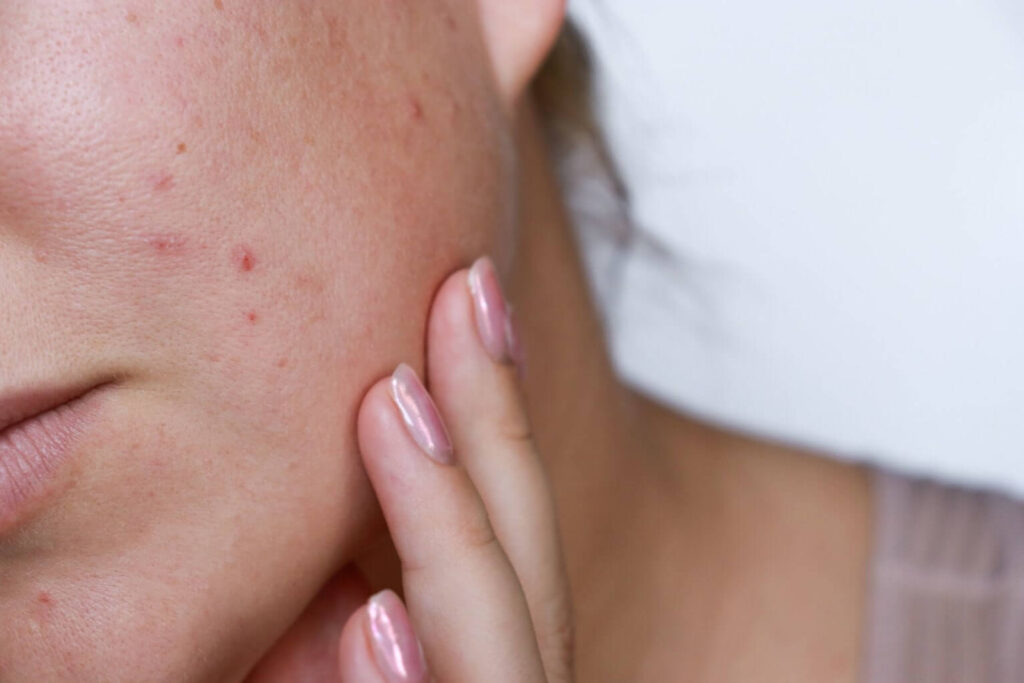 Close-up of a woman with acne