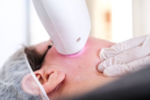 Woman receiving MOXI Laser treatment at EpiCentre Skin Care & Laser Center in Dallas