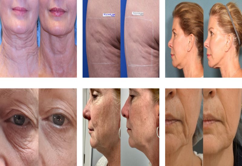 Before and after Sofwave treatment photos at EpiCentre Skin Care & Laser Center in Dallas