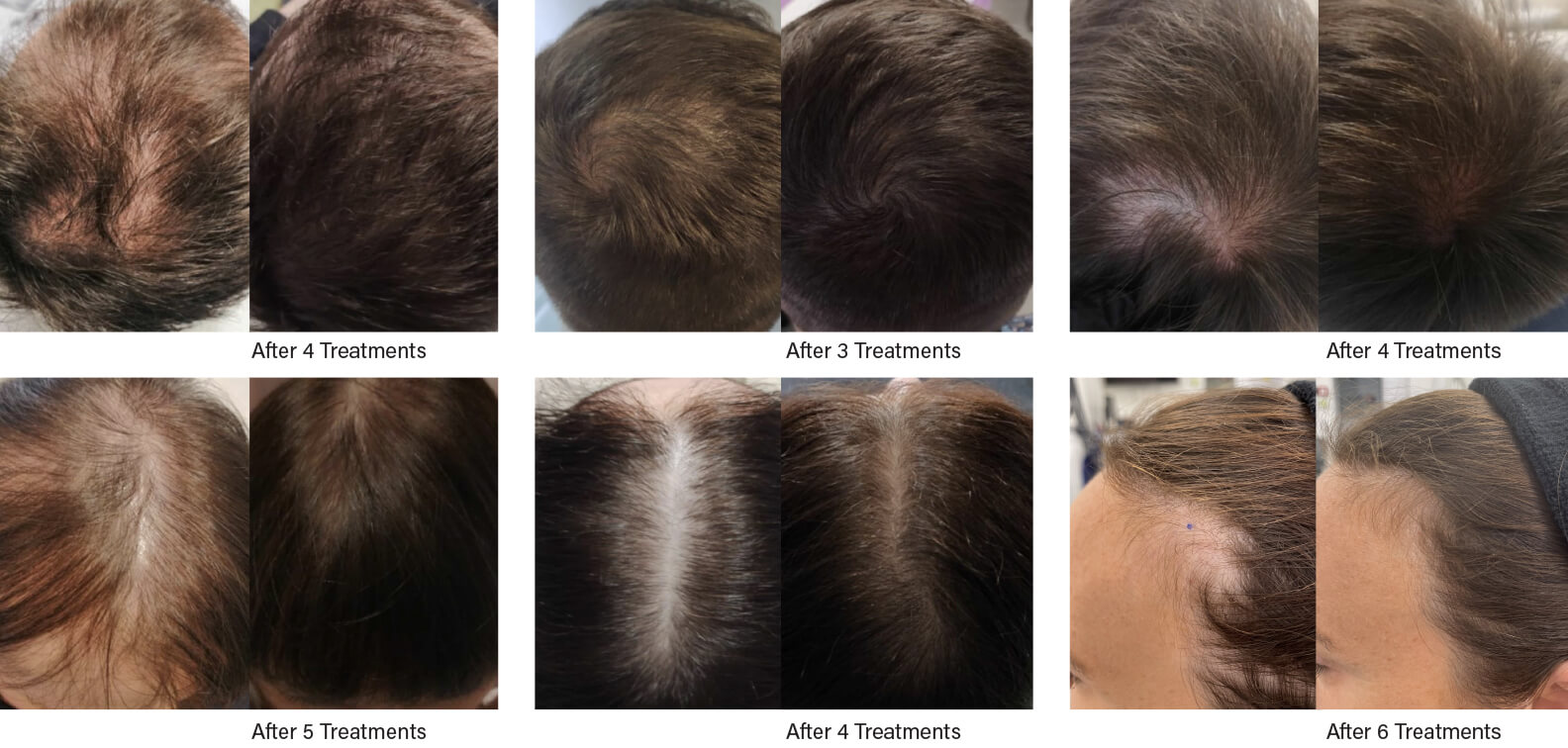 Before and after mutliple FoLix treatments