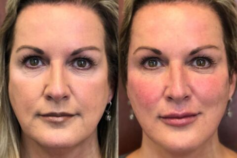 Injectable filler procedure results showing enhanced facial volume in Dallas & the nearby area