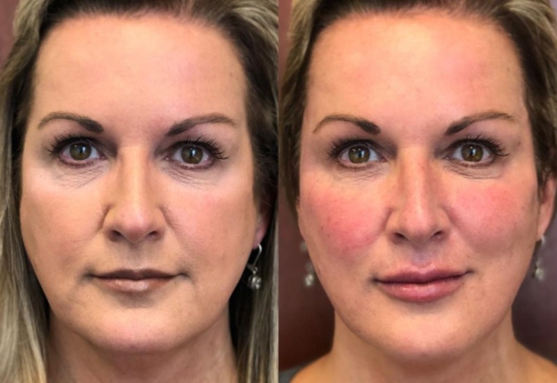 Injectable filler procedure results showing enhanced facial volume in Dallas & the nearby area