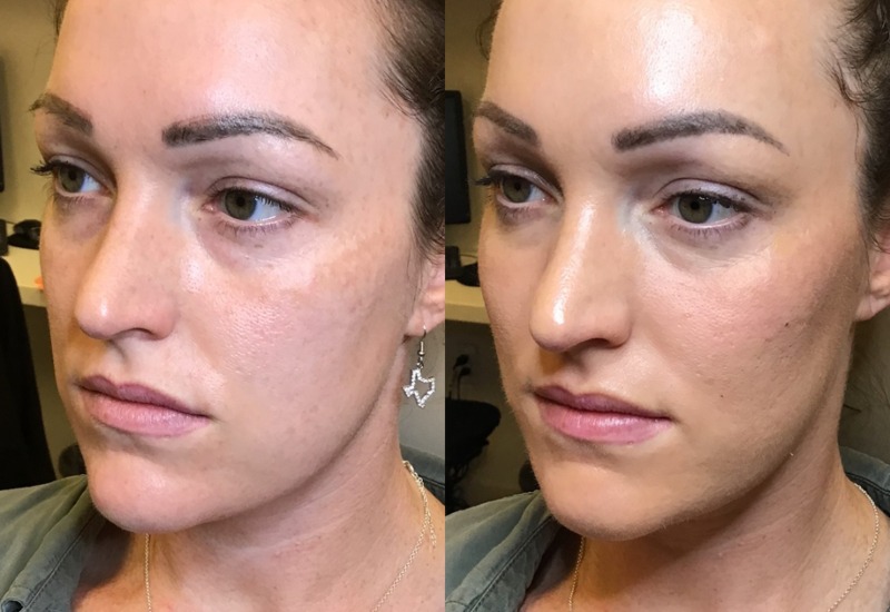Close-up view of before and after skincare treatment in Dallas, TX, and the surrounding area