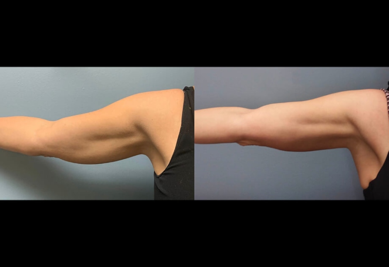 Professional body treatment results showing improved upper arms in Dallas & the nearby area