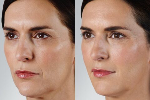 Professional skincare treatment results showing improved skin texture in Dallas & the nearby area