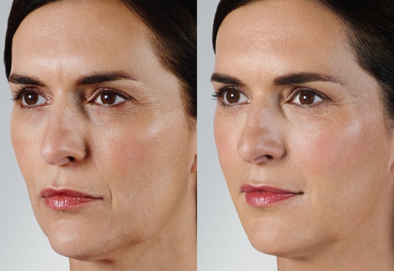 Professional skincare treatment results showing improved skin texture in Dallas & the nearby area