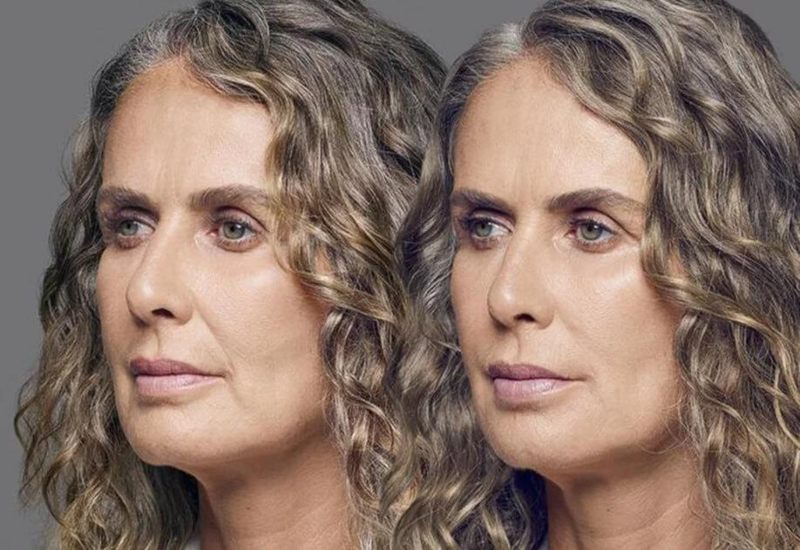 Side-by-side laser therapy results highlighting enhanced skin quality in Dallas & the nearby area