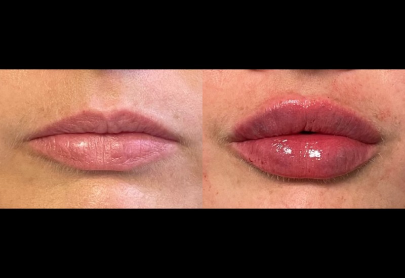 Side-by-side injectable filler results highlighting lip fullness in Dallas & the nearby area